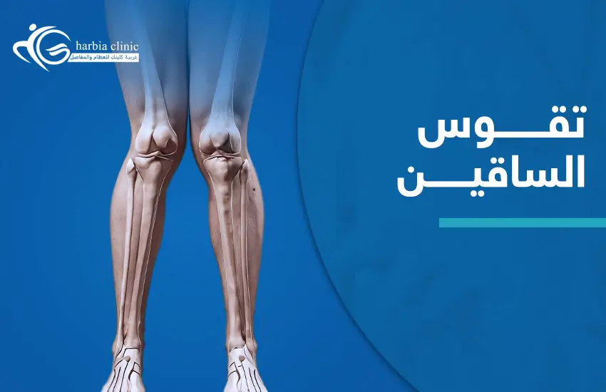 تقوس الساقين