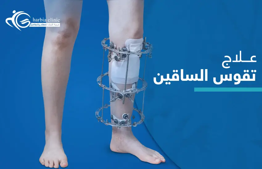 علاج-تقوس-الساقين علاج تقوس الساقين