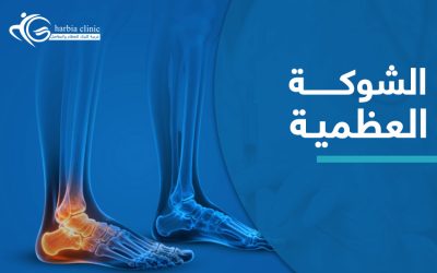 الشوكة العظمية | الأعراض والأسباب وطرق العلاج 