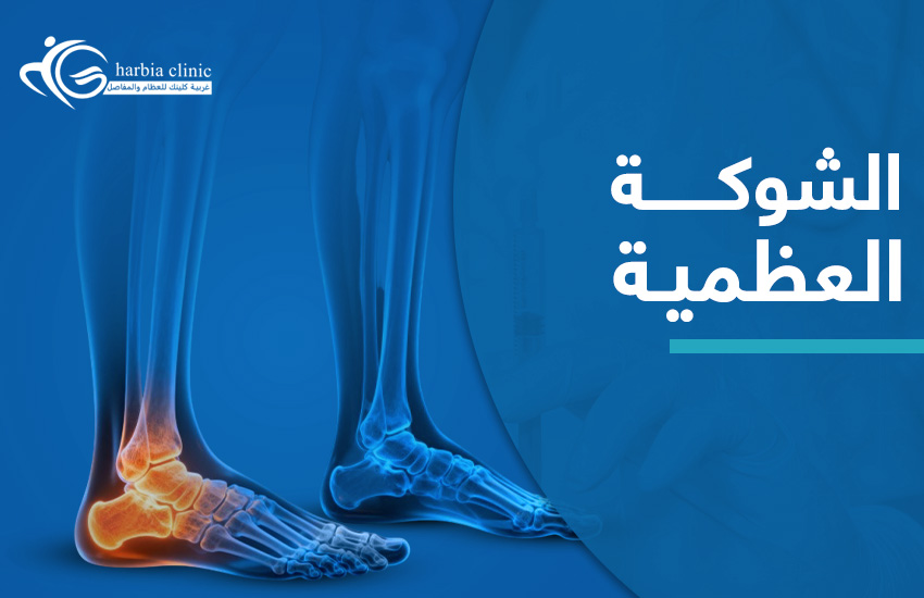 الشوكة العظمية