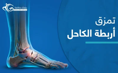 ما هو تمزق أربطة الكاحل؟ وهل هو خطير؟
