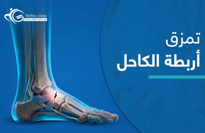 تمزق أربطة الكاحل